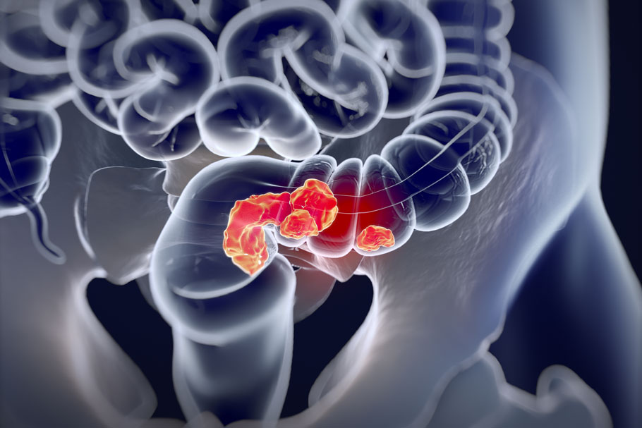 Best Practice: Colorectal Cancer Service